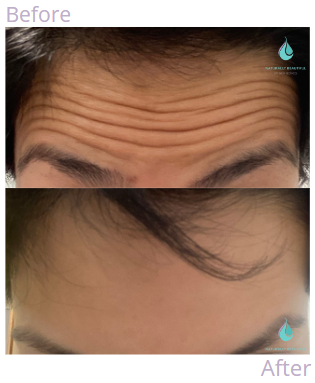 Anti Wrinkle 1