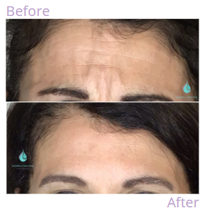 Anti Wrinkle 2