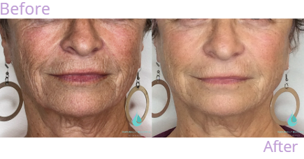 Collagen biostimulator 1