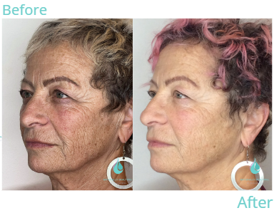 Collagen biostimulator 2