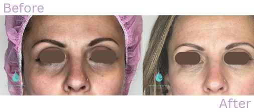 Dermal Filler 4