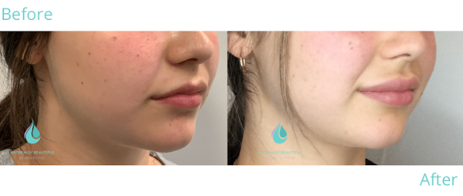 Dermal filler 2