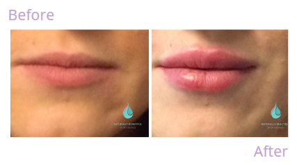 Dermal filler 3