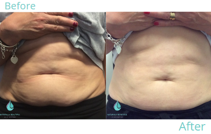 Fat Freezing 1