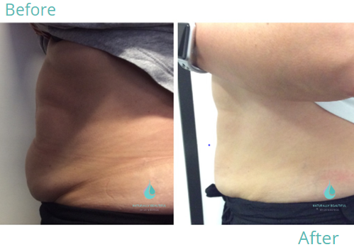 Fat Freezing 2